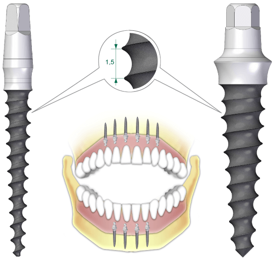 A gömbfejű Conefit Slim implantátumok kivehető fogművekhez alkalmazhatók, 2-6 implantátum beültetésével.