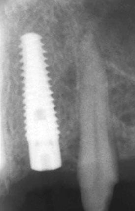 Mandibulába és maxillába behelyezett scandrea implantátumok