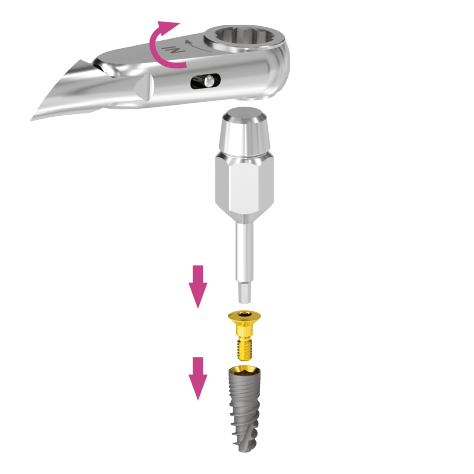A racsnis nyomatékkulcs alkalmazása. Az implantátumba a zárócsavart kézi behajtókulcs segítségével csavarjuk be, a racsnis nyomatékkulcs segítségével. A kívánt nyomatékok 15 Ncm-től jobbra forgatással állíthatók be. 